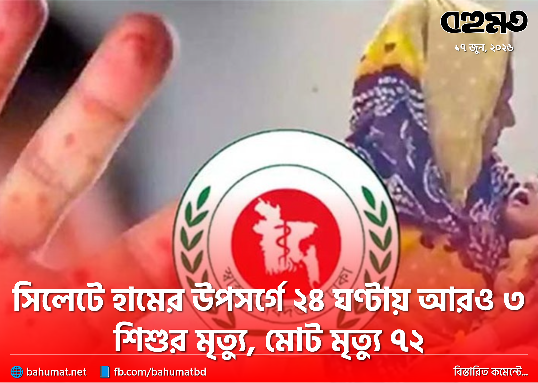 সিলেটে হামের উপসর্গে ২৪ ঘণ্টায় আরও ৩ শিশুর মৃত্যু, মোট মৃত্যু ৭২