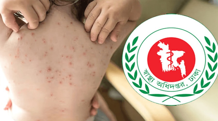 হাম ও উপসর্গে সারা দেশে আরও ৫ শিশুর মৃত্যু
