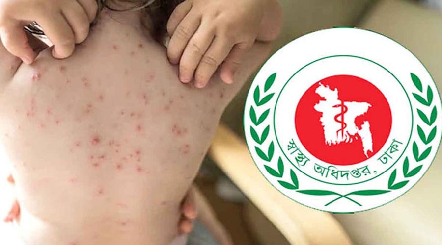 হামের উপসর্গে আরও ৬ শিশুর মৃত্যু, ২৪ ঘণ্টায় আক্রান্ত ৮১৮